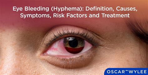 blood leaking from eye|Eye bleeding: Types, causes, treatment, and seeking。